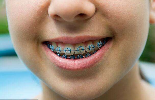 常见的情况如:牙齿的唇向或舌向错位(虎牙