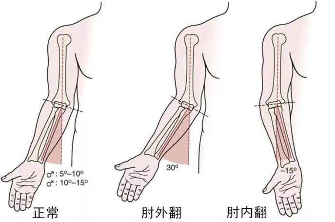 正常情况下,我们正常的肘关节自然肘外翻的角度的,正常范围在10~15度