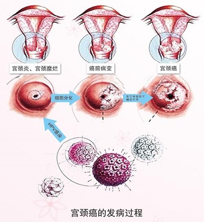 宫颈贴膜贴上后的图片图片