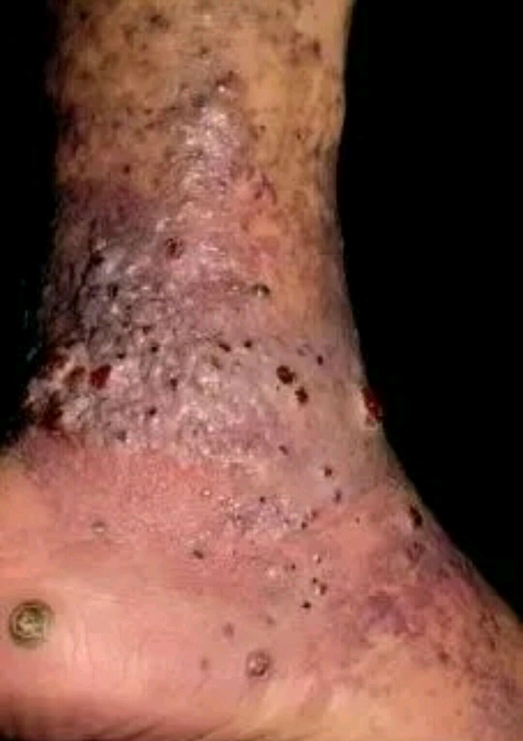 rous肉瘤病毒图片