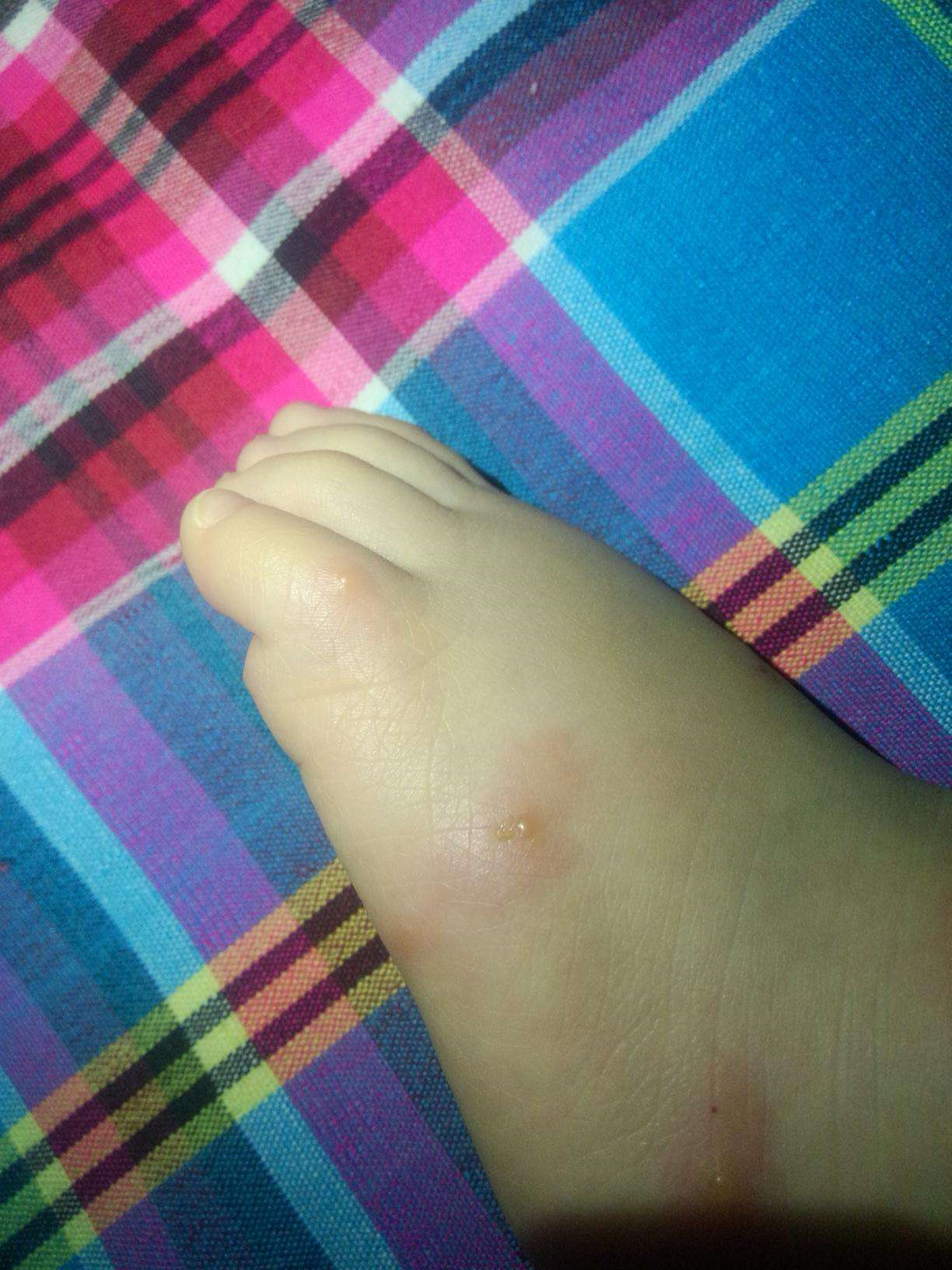 虫咬皮炎(丘疹性荨麻疹)家长如何应对?