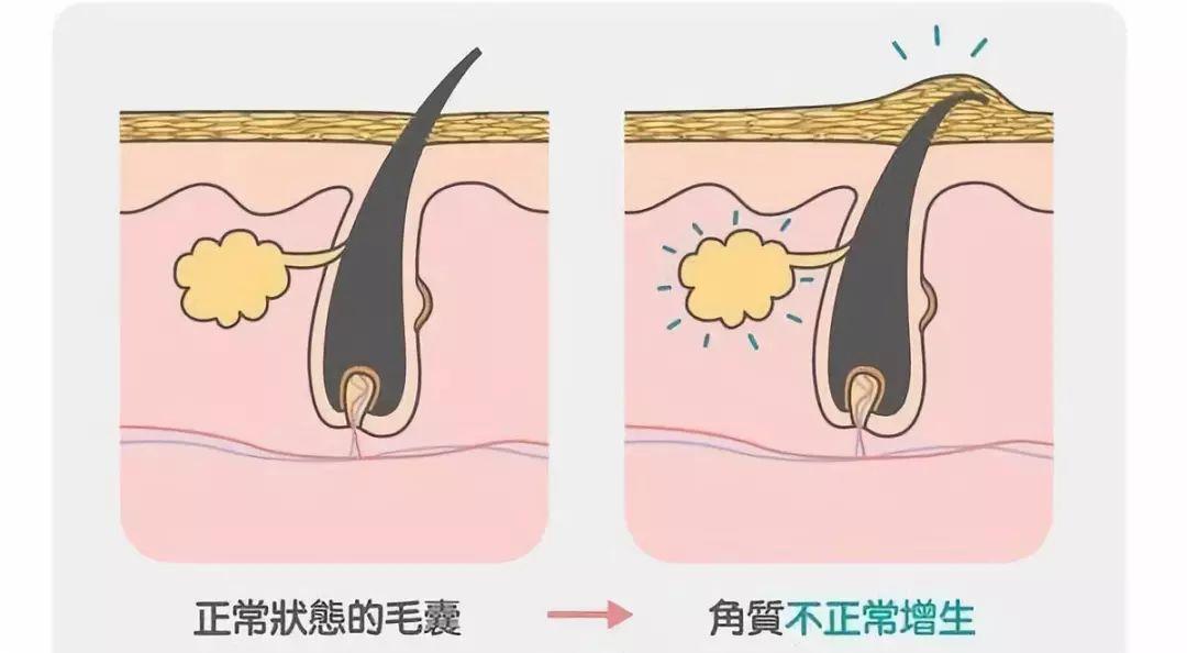 经常起鸡皮肤是为什么(鸡皮肤是什么原因引起的?)