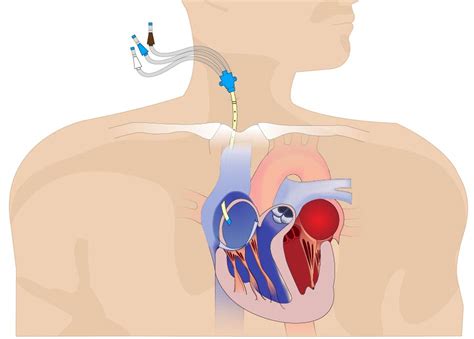 什么是中心静脉压?