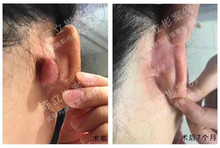 耳部疤痕疙瘩术后7月复诊