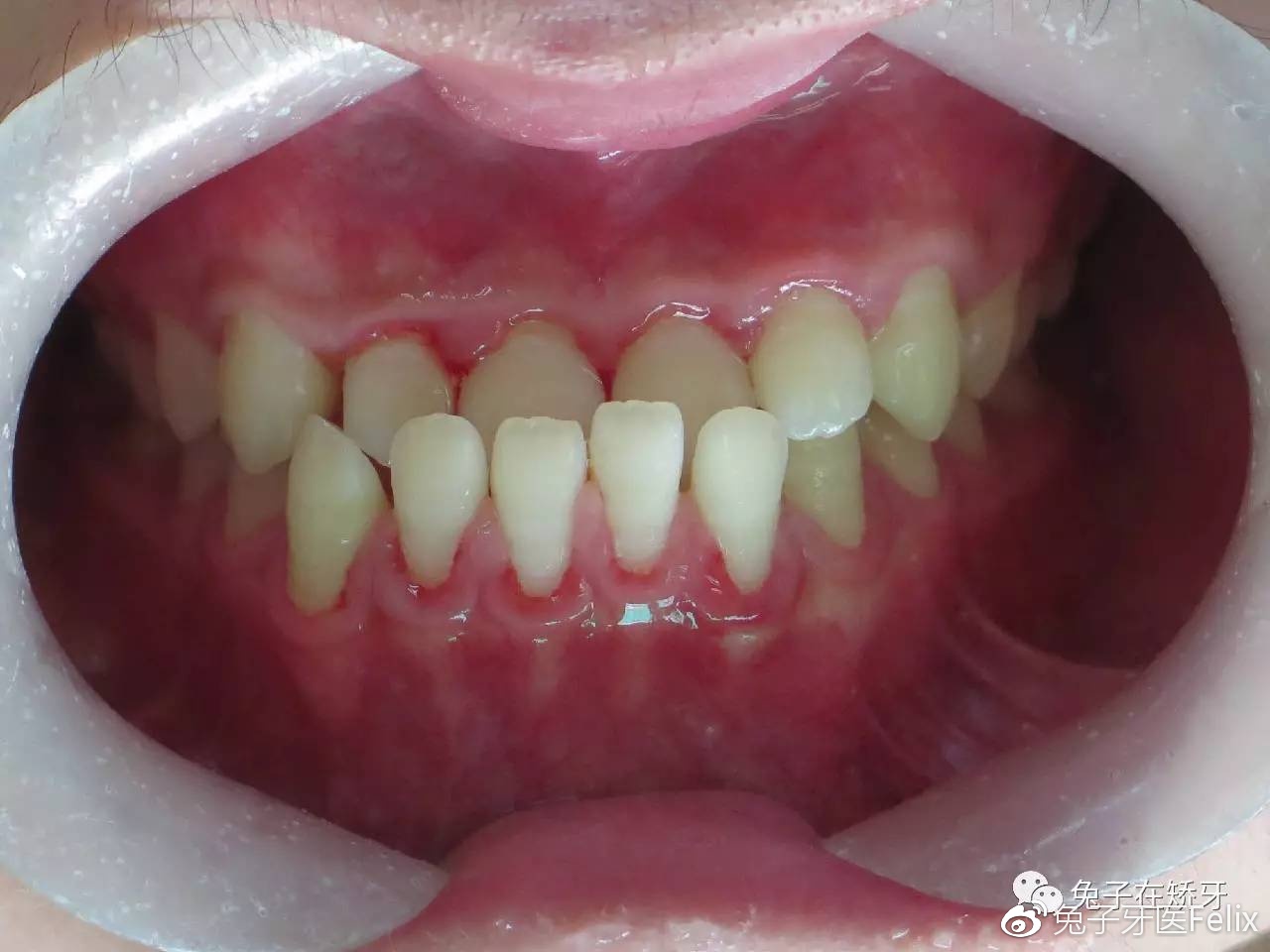 恒牙期前牙反颌