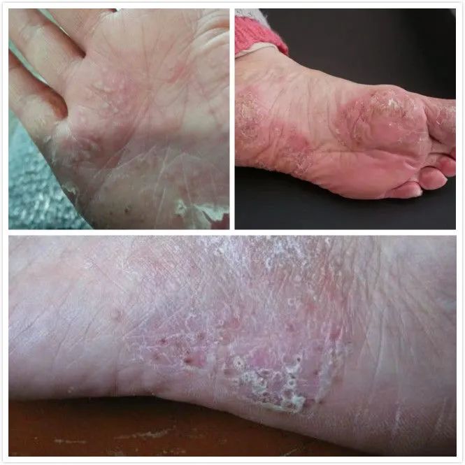 你知道中医是如何治疗掌跖脓疱病的?