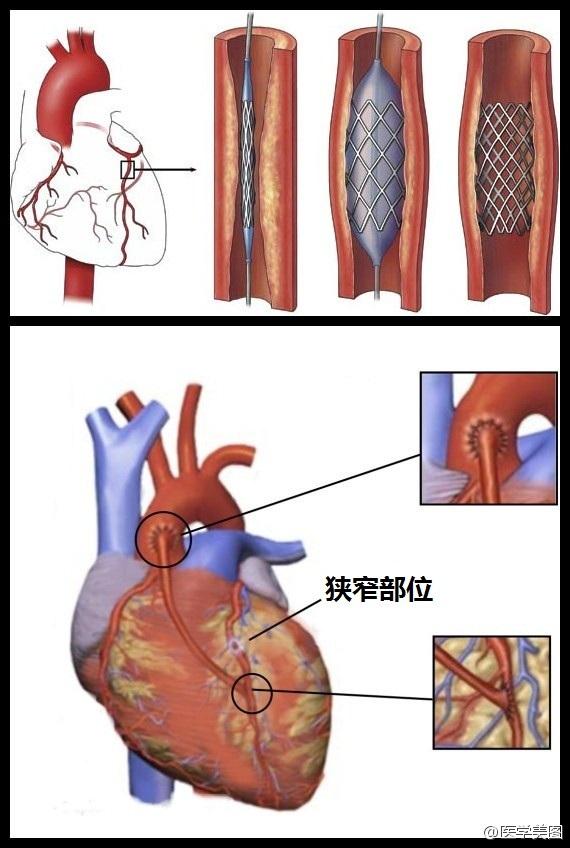 心脏三根血管图片