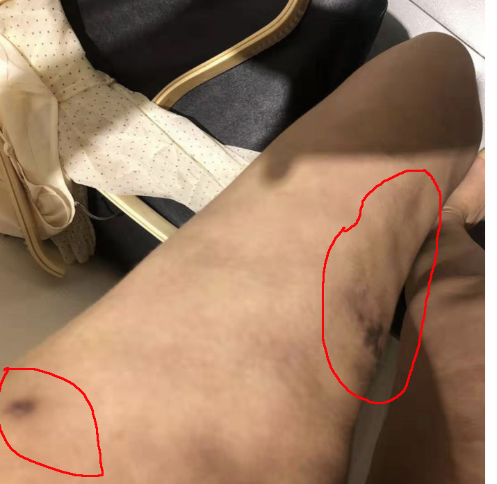 吸脂失败的表现有哪些?如何修复?多久修复?