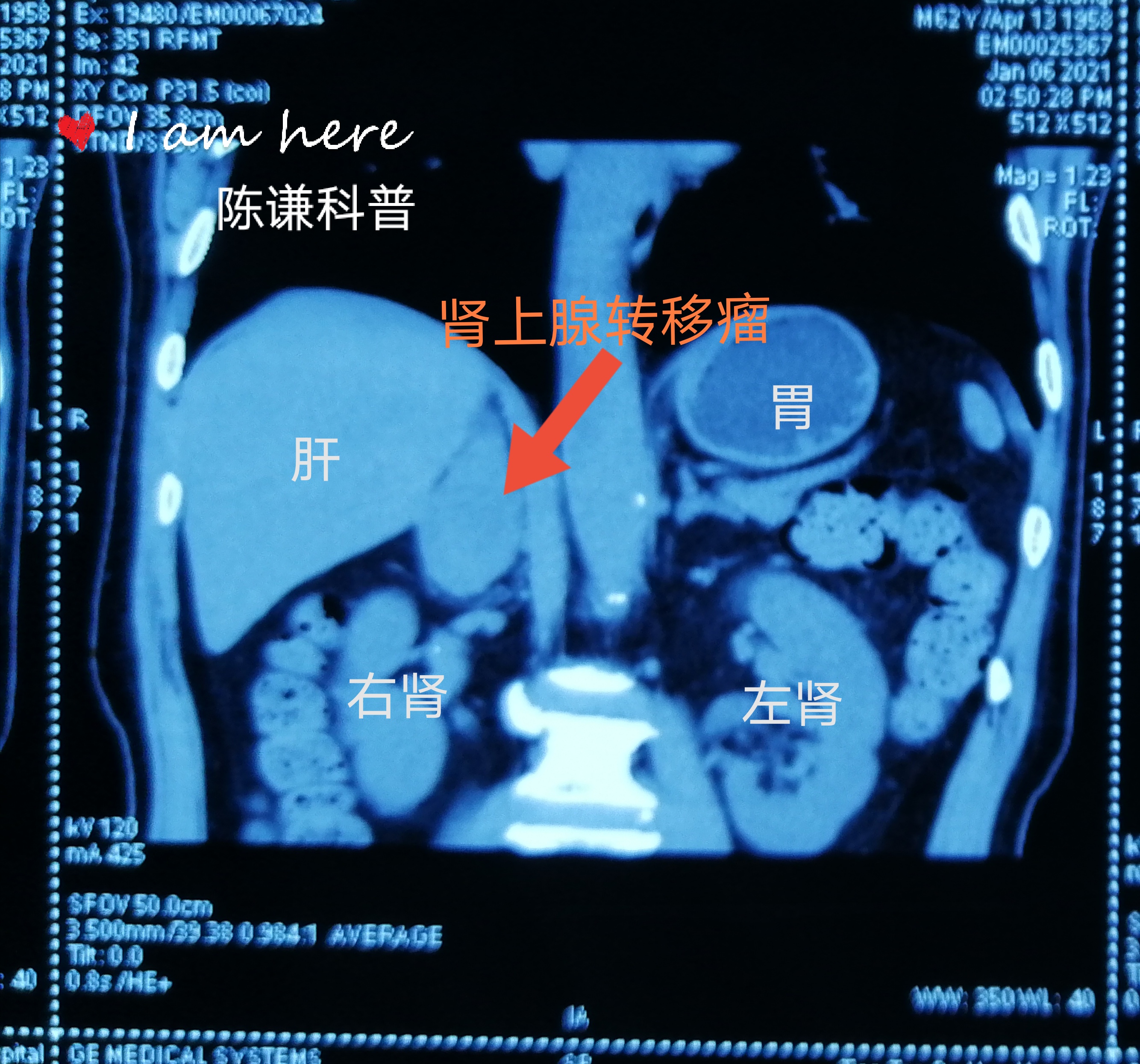 陈谦主任科普之CT检查