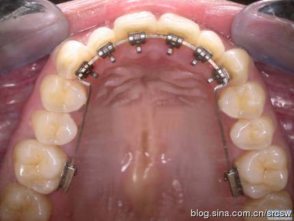 戴用舌侧矫治器的注意事项 鹰潭牙齿隐形矫正