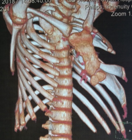 颈肋畸形图片
