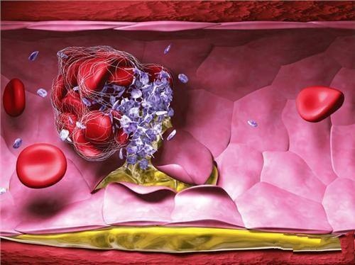 人体能自动消除血栓吗