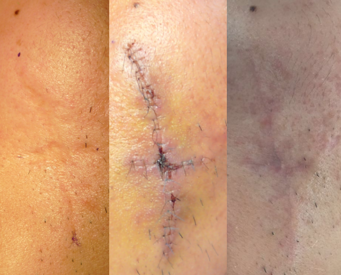 十字交叉形状的疤痕应该如何切除?