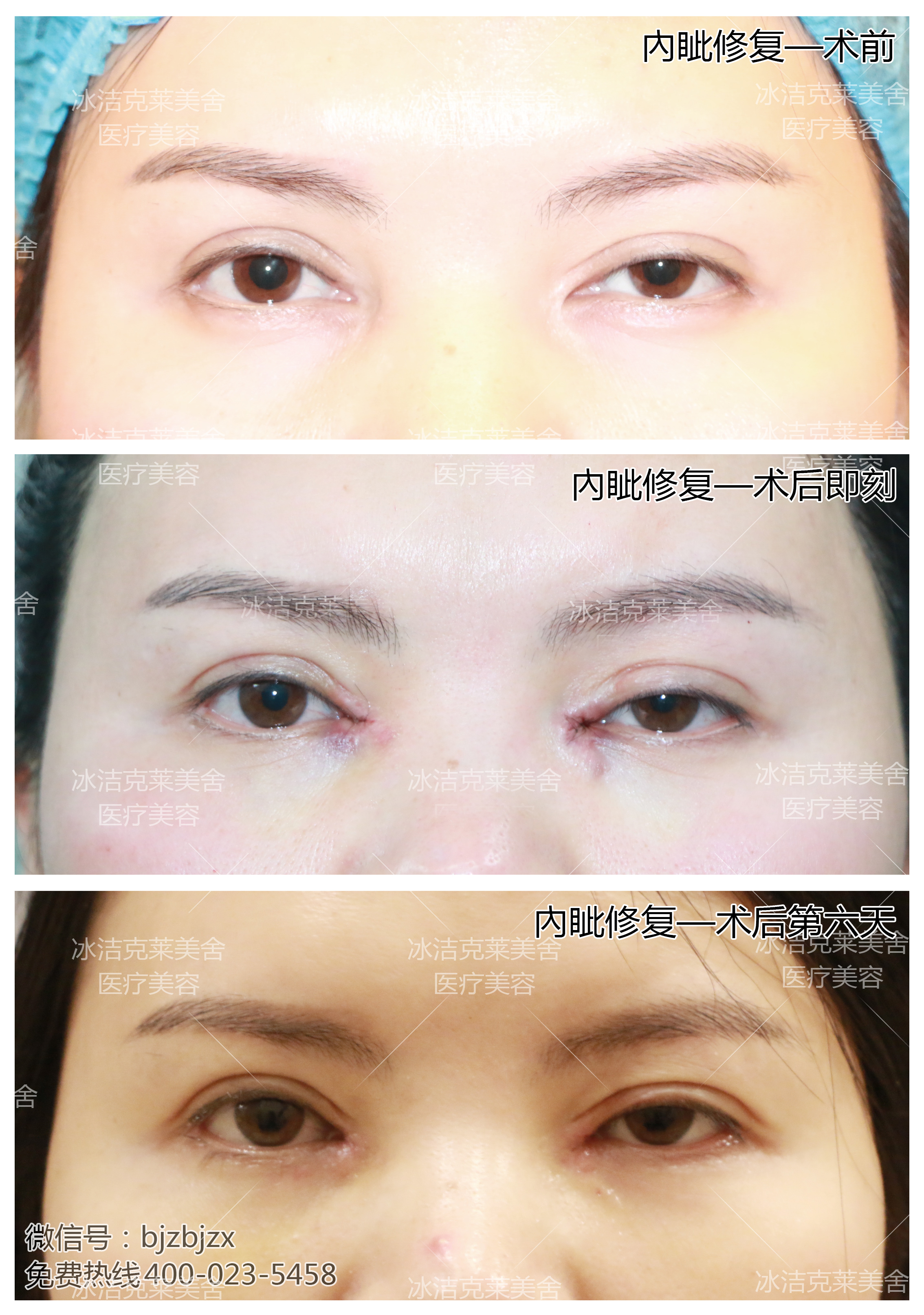 内眼角修复 | 内眼角疤痕修复部分案例-张冰杰主治医师-爱问医生