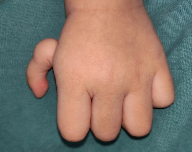 拇指发育不良如何分型严重的拇指发育不良应该如何治疗