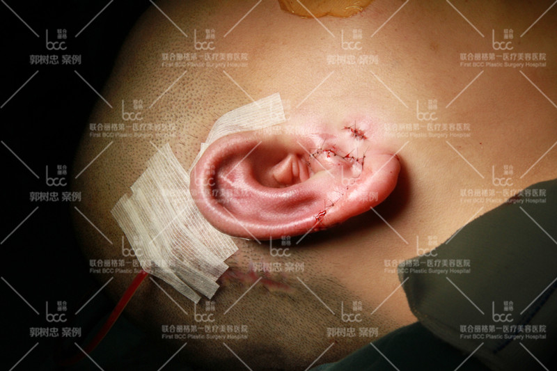 小耳症那些事儿十二再造的耳朵为什么会发紫肿胀