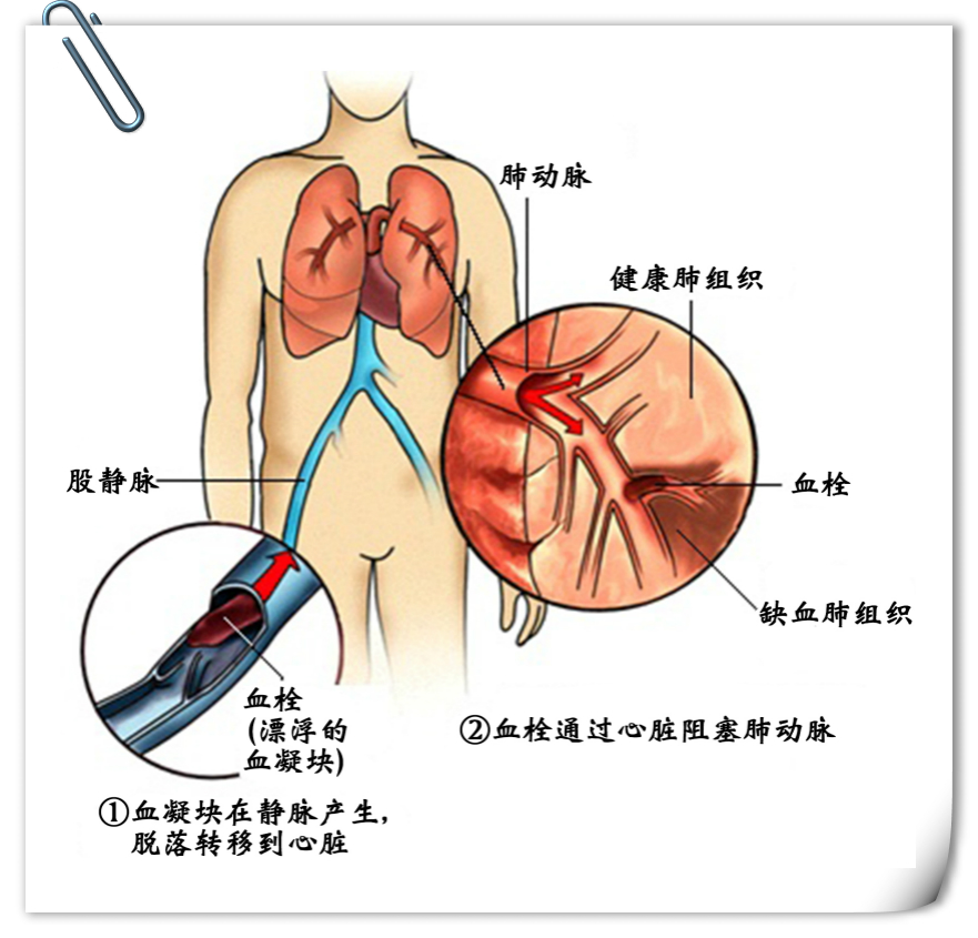 血栓致死性心血管疾病之源世界血栓日