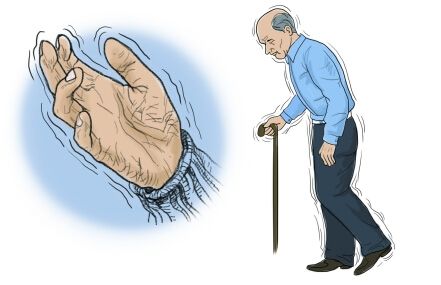 太极拳可改善帕金森患者病情-陈鸿耀副主任医师-爱问医生