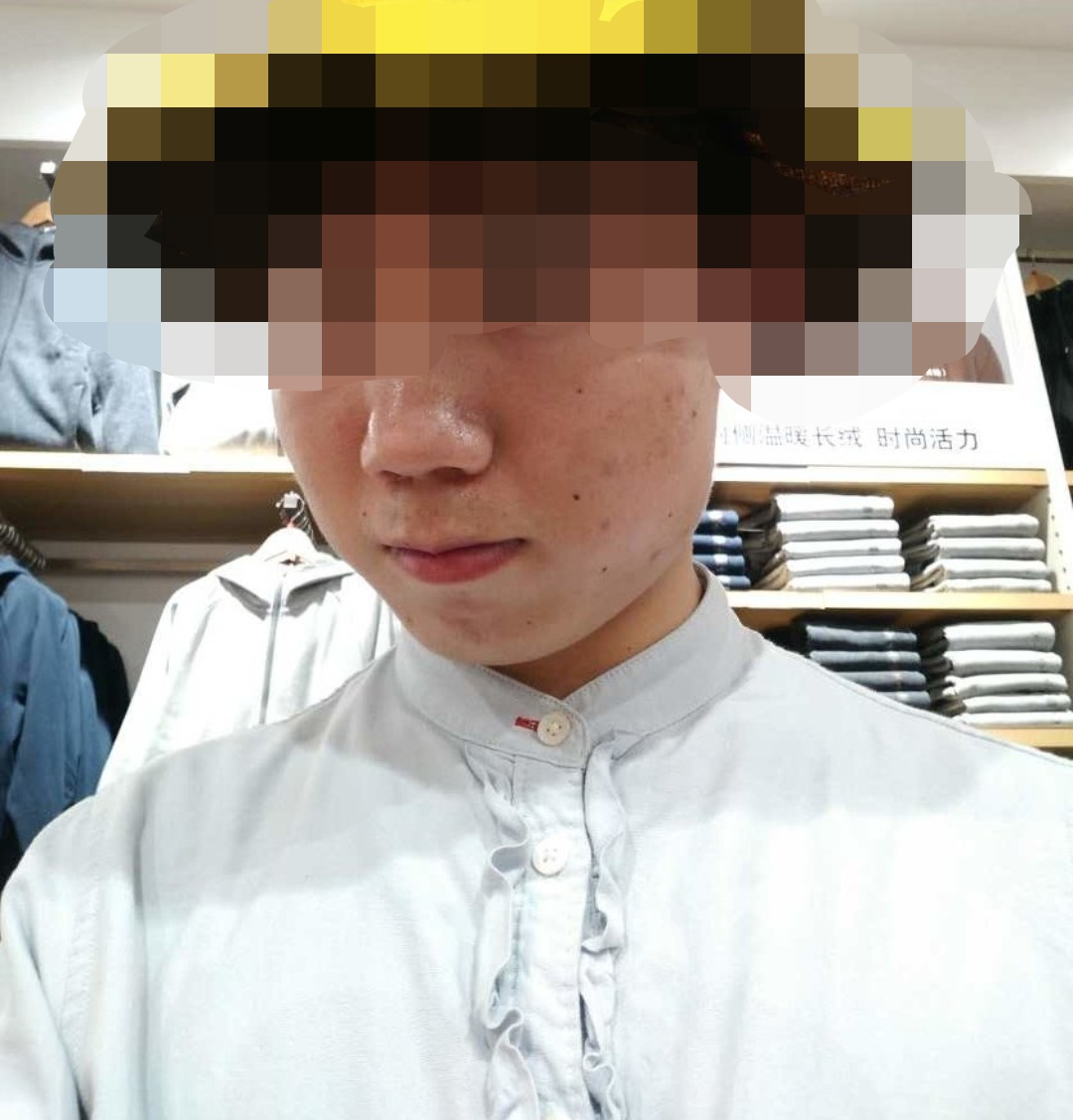 皮肤科董医生:1例痤疮患者不当疹疗浅析