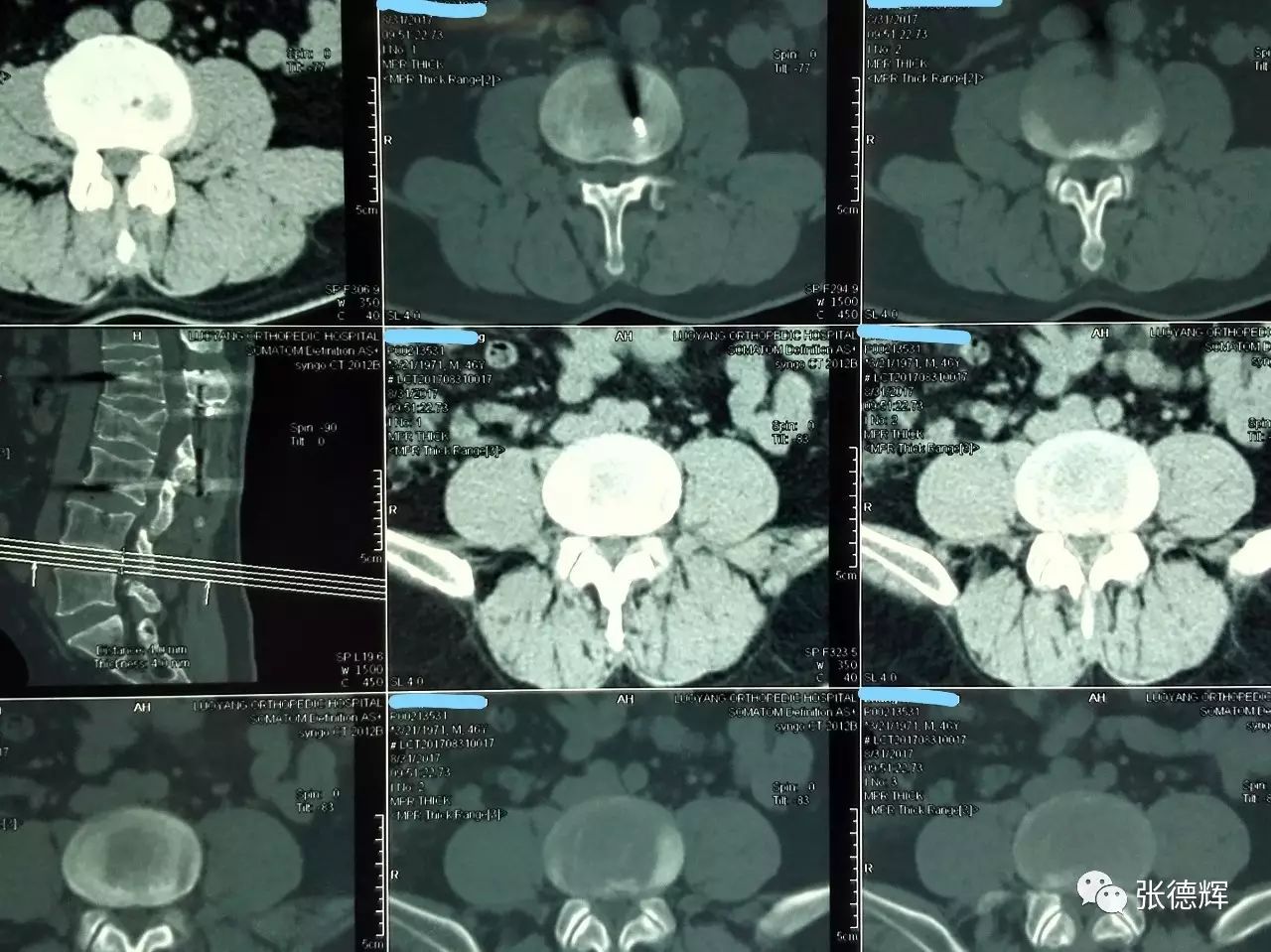 腰椎內固定存留16年的腰椎管狹窄患者!