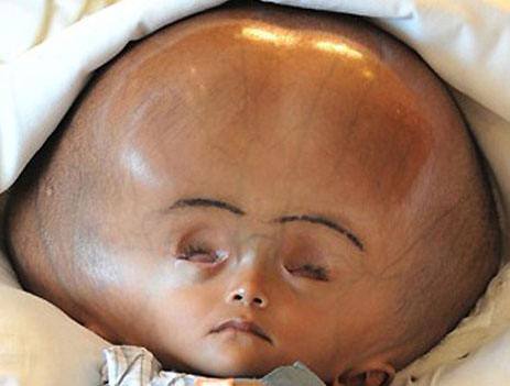 关爱孩子孩子头大是聪明么不仅不一定聪明很可能是病