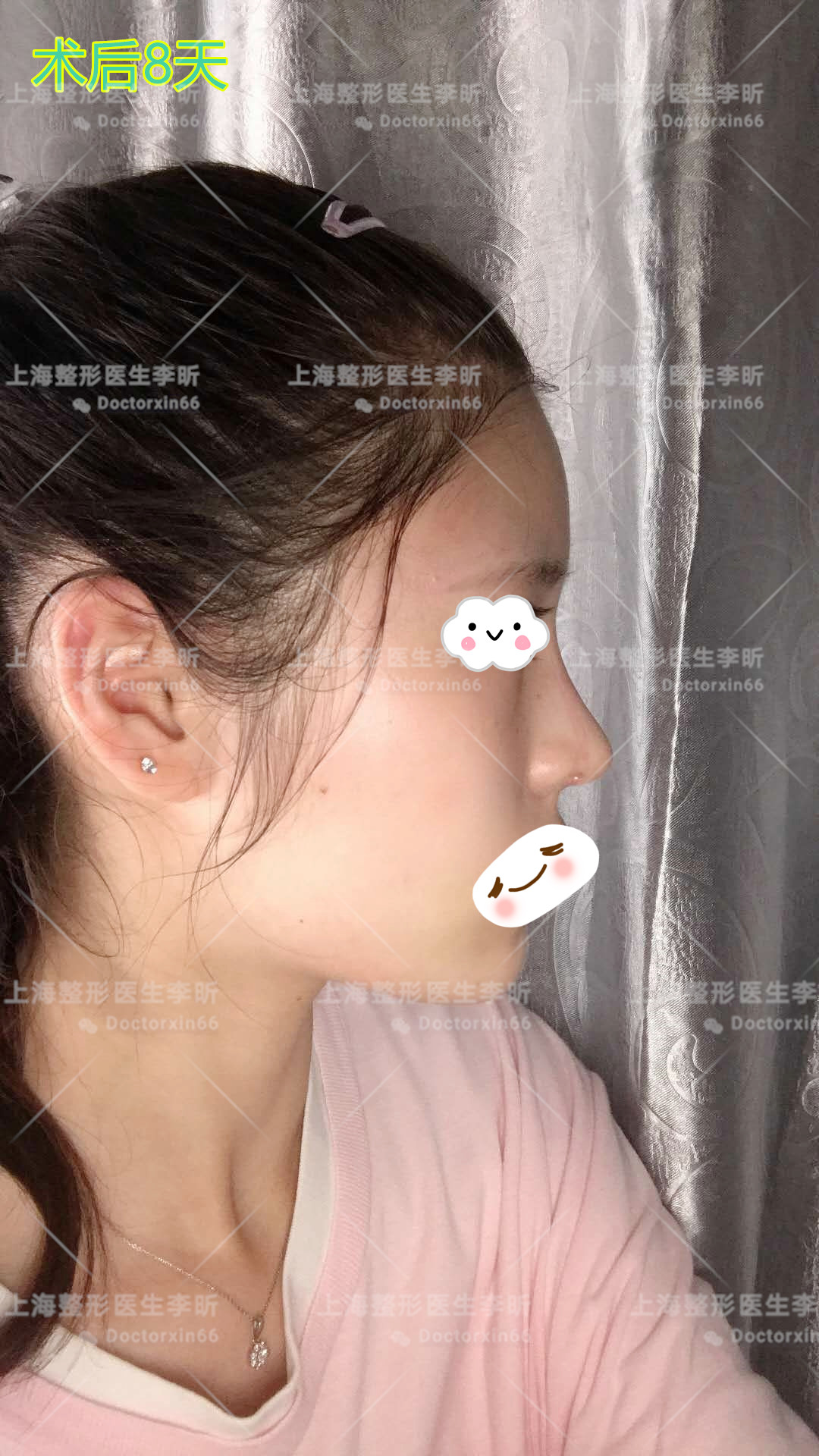 上海隆鼻资源分析，在上海隆鼻、鼻修复看这篇文章就够了（内附大量素人真实上海隆鼻案例） - 知乎