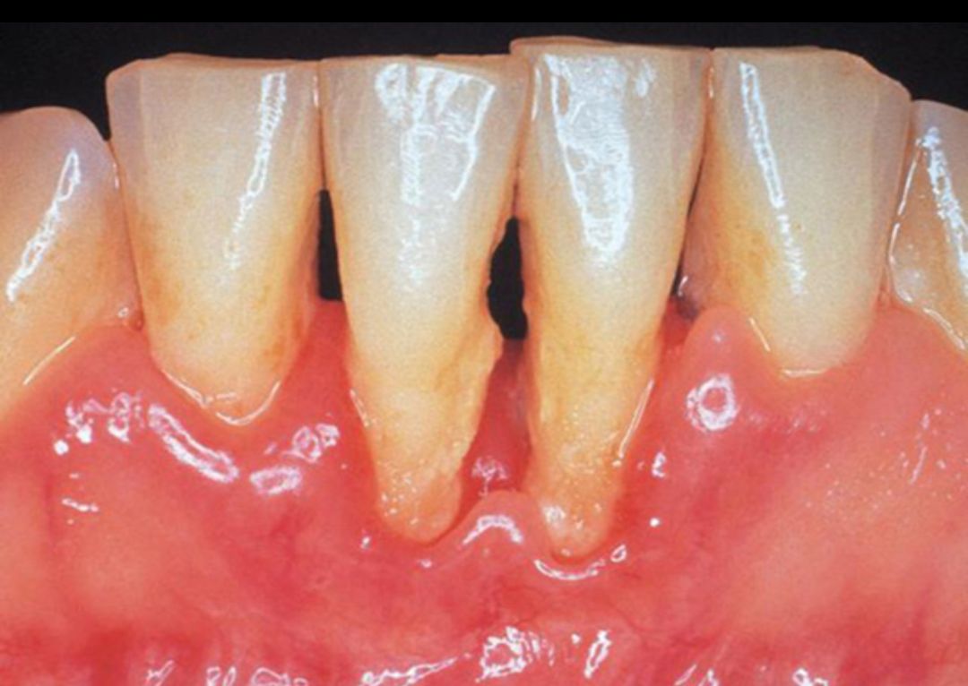 牙周病正在悄悄侵袭你的口腔健康