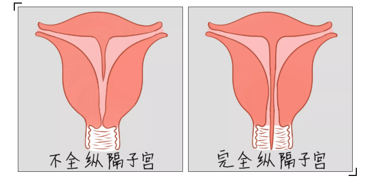 子宫在胚胎发育的过程中是由左右两边的一个叫苗勒氏管的组织在中间