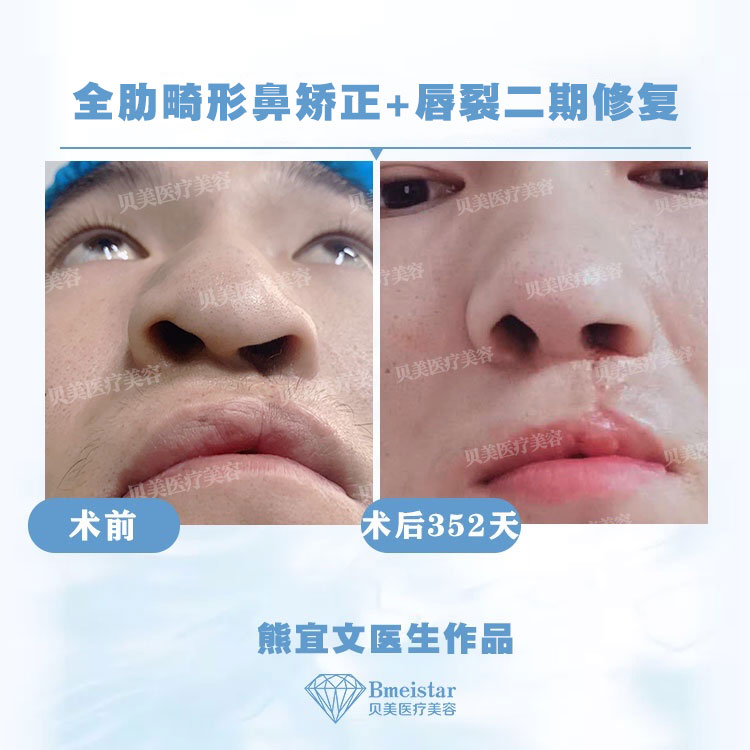 全肋畸形鼻矫正 唇裂二期修复