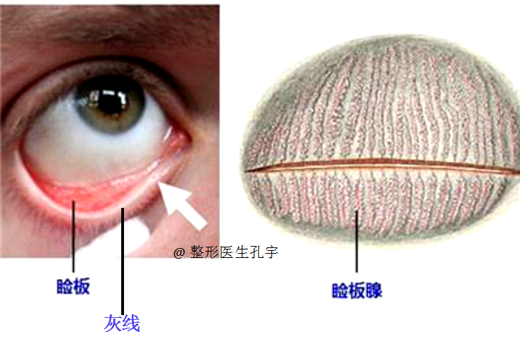 做双眼皮会得干眼症吗?