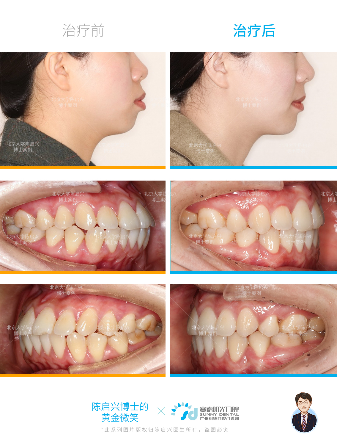 牙性前突和骨性前突图片