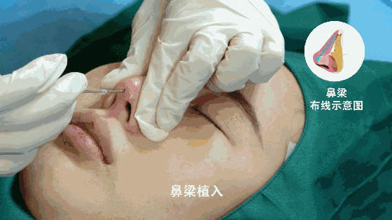 线雕隆鼻让你的鼻子挺翘颜值变高