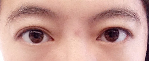 双眼皮宽窄不对称.jpg