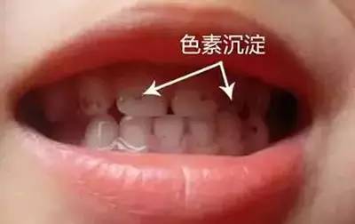 牙垢革兰染色图片