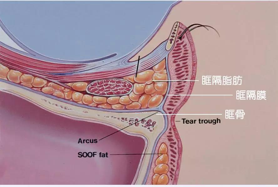 眶隔脂肪在哪里图片