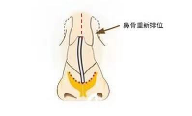 如何让歪鼻改 斜 归正 王会勇副主任医师 爱问医生