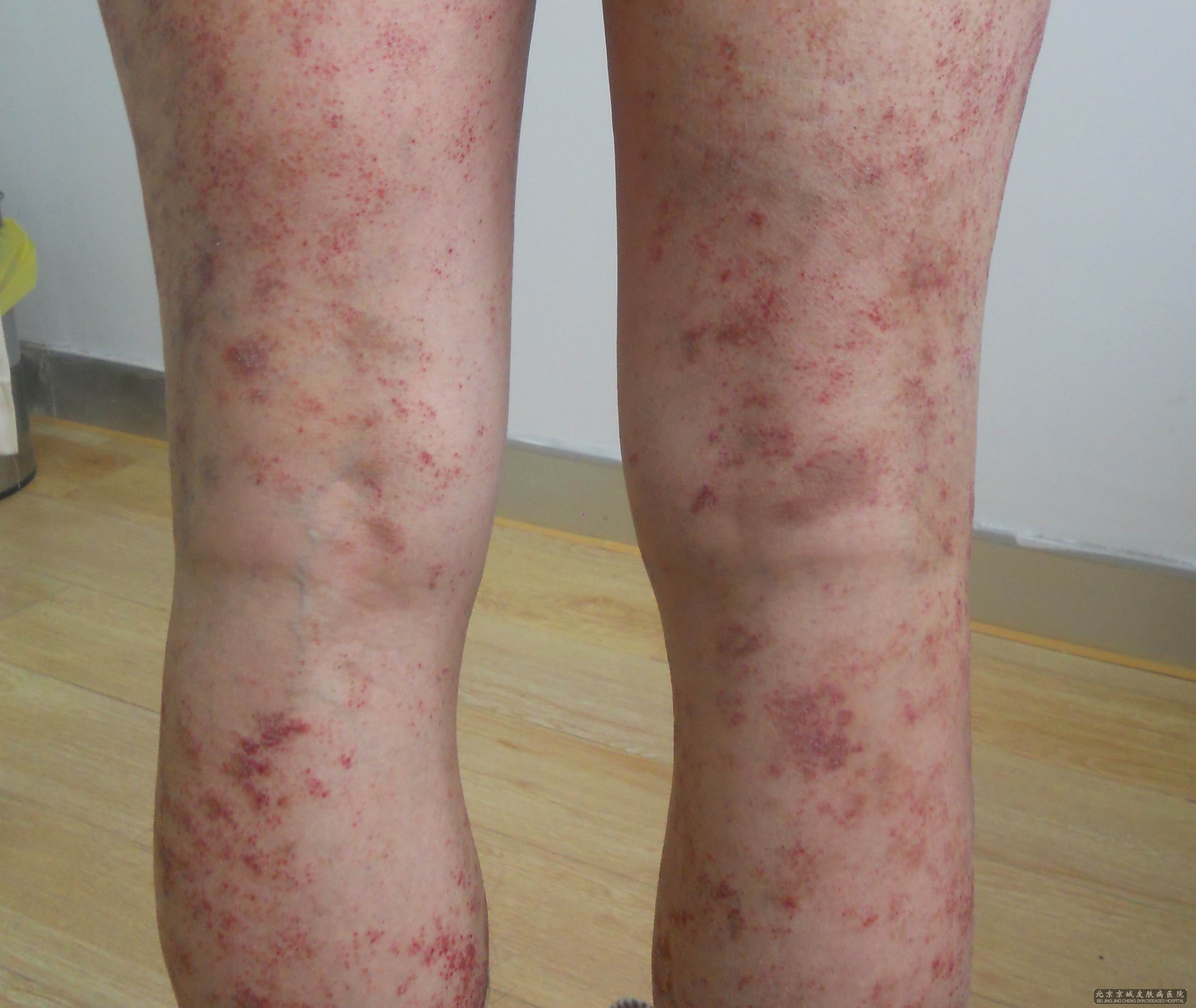 hiv早期皮肤的症状图片图片