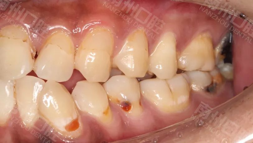 上前牙贴面修复案例分享