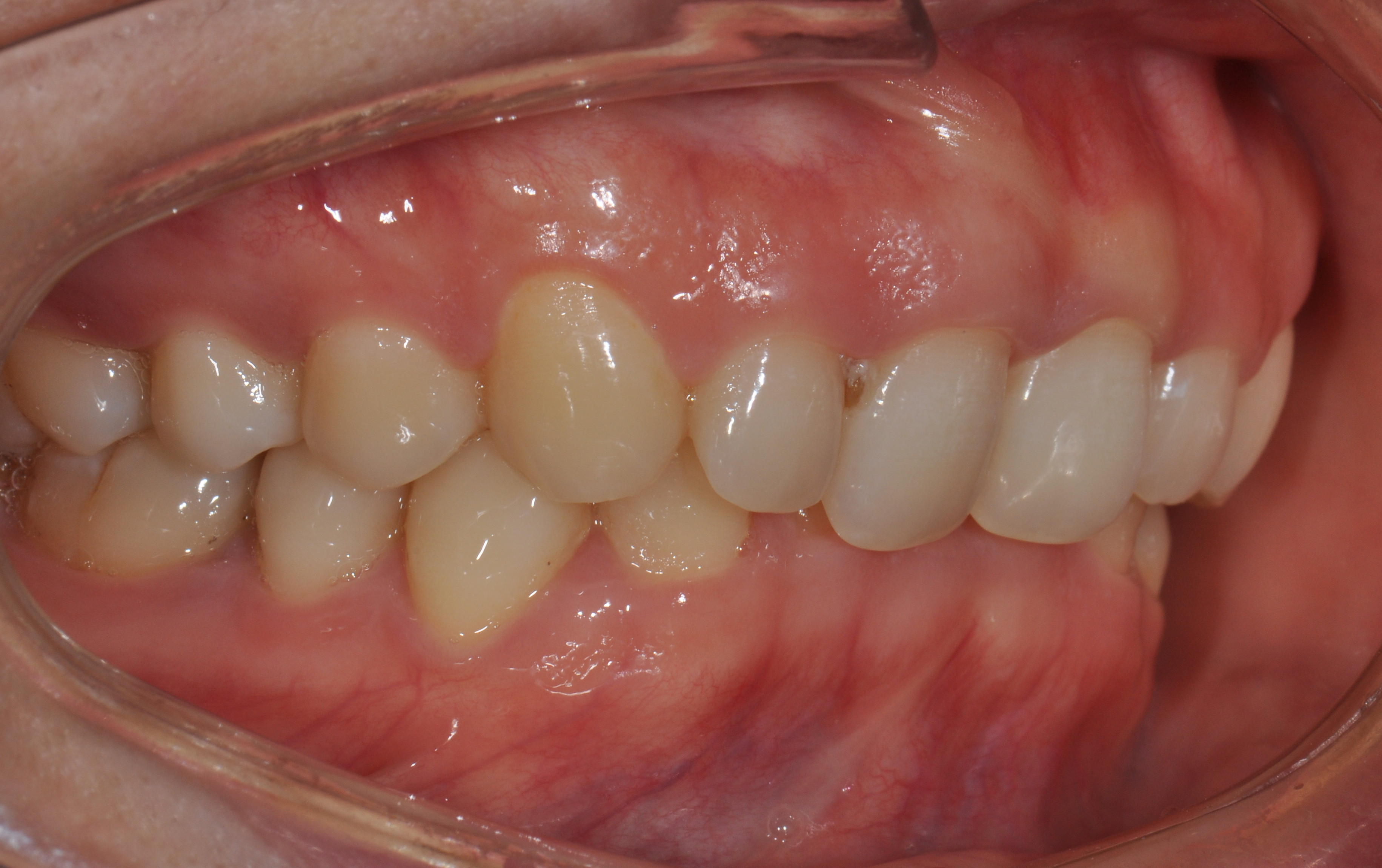 露牙龈的笑容,你觉得美吗?(上)