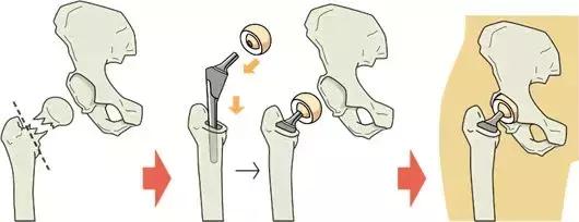 股骨颈骨折保守图片