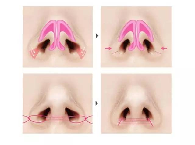 手术方法:切除部分鼻翼之游离缘,修整后切口缝合至鼻翼内面