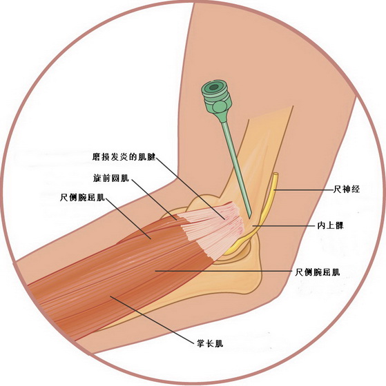 肘关节伸肌总腱位置图图片