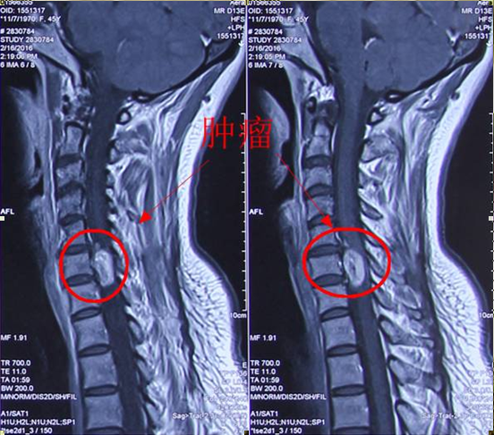 病例:高頸段神經鞘瘤一例