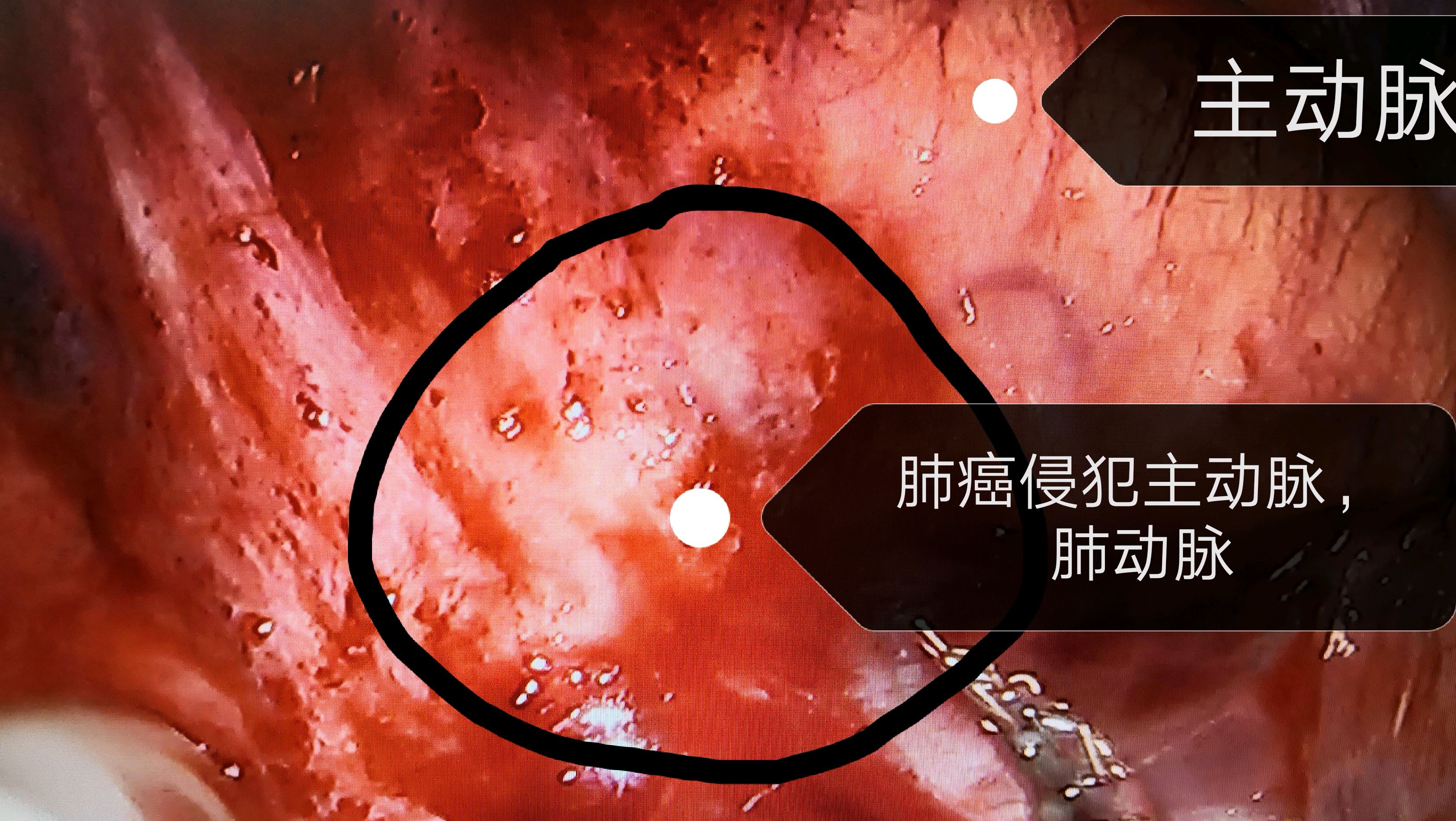 腿痛脚肿发烧不是风湿吗怎么会是晚期肺癌