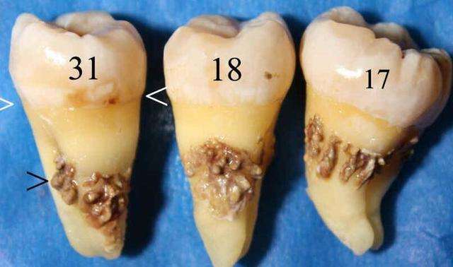 牙结石的分度图片图片