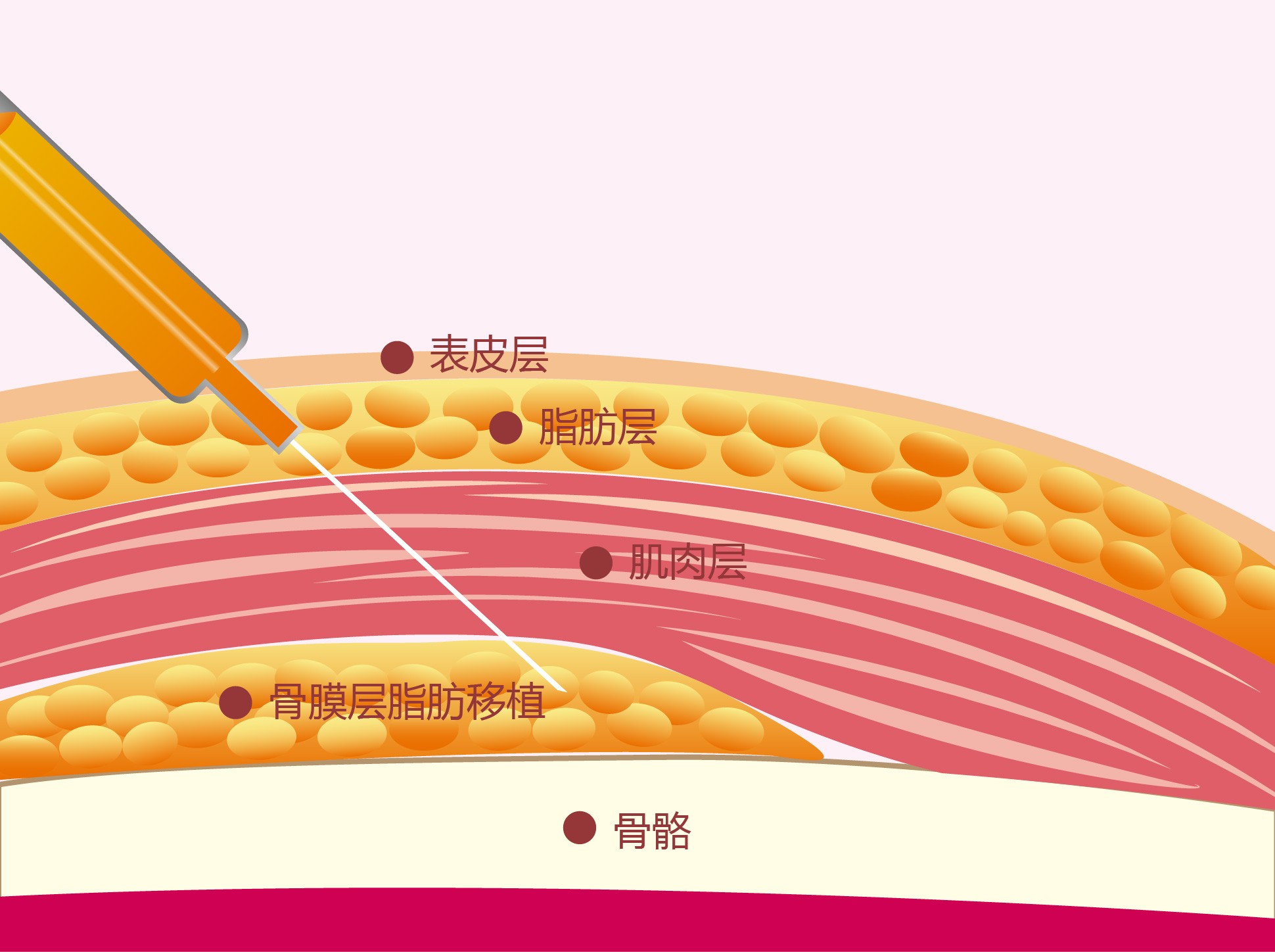 脂肪填多了,要怎么修复