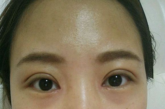 双眼皮手术后为什么会出现难看的"肉条? 又该如何修复呢