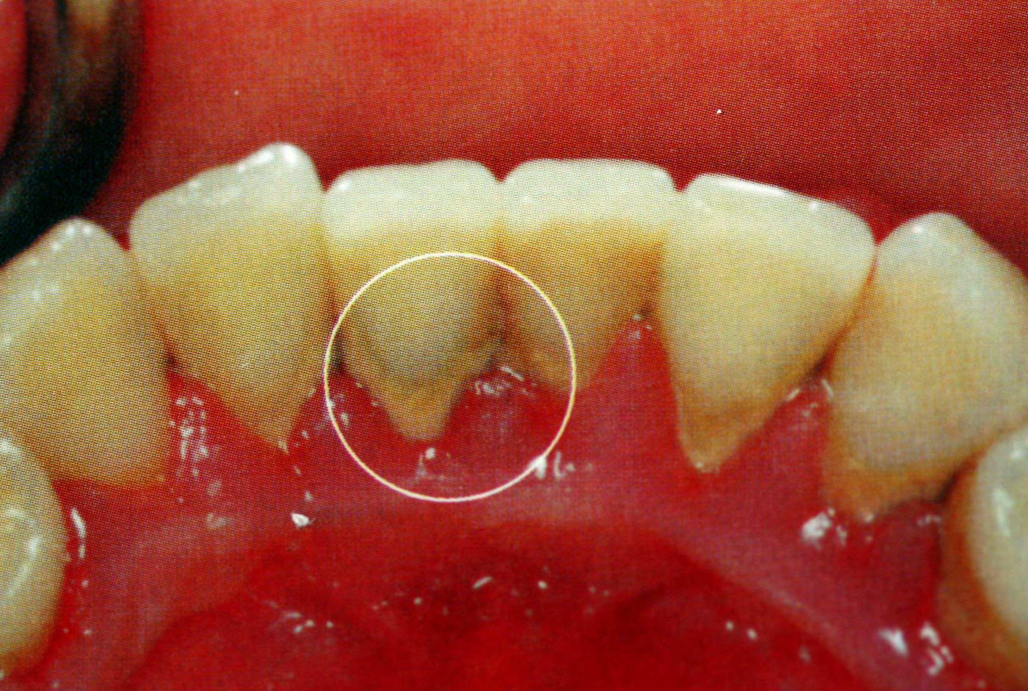 1,牙菌斑牙结石黑三角产生原因:对于黑三角,我们总是无可奈何,其实并