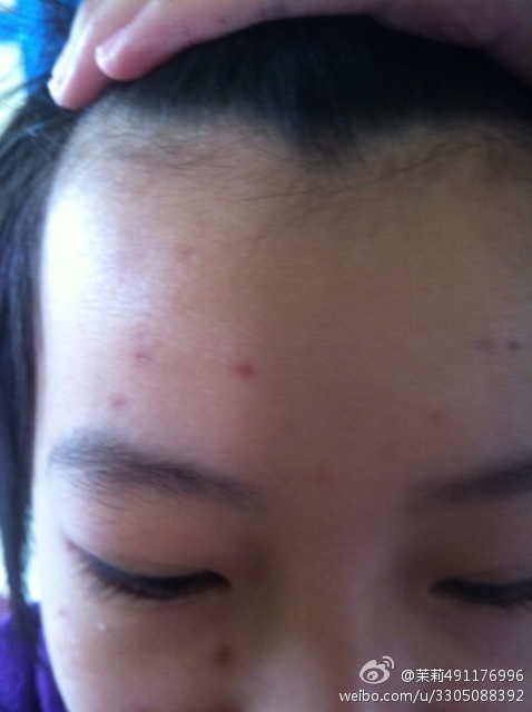 请问,女孩11岁,出水痘两个半月了,脸上的水痘印还很深,请 - 新浪旗下