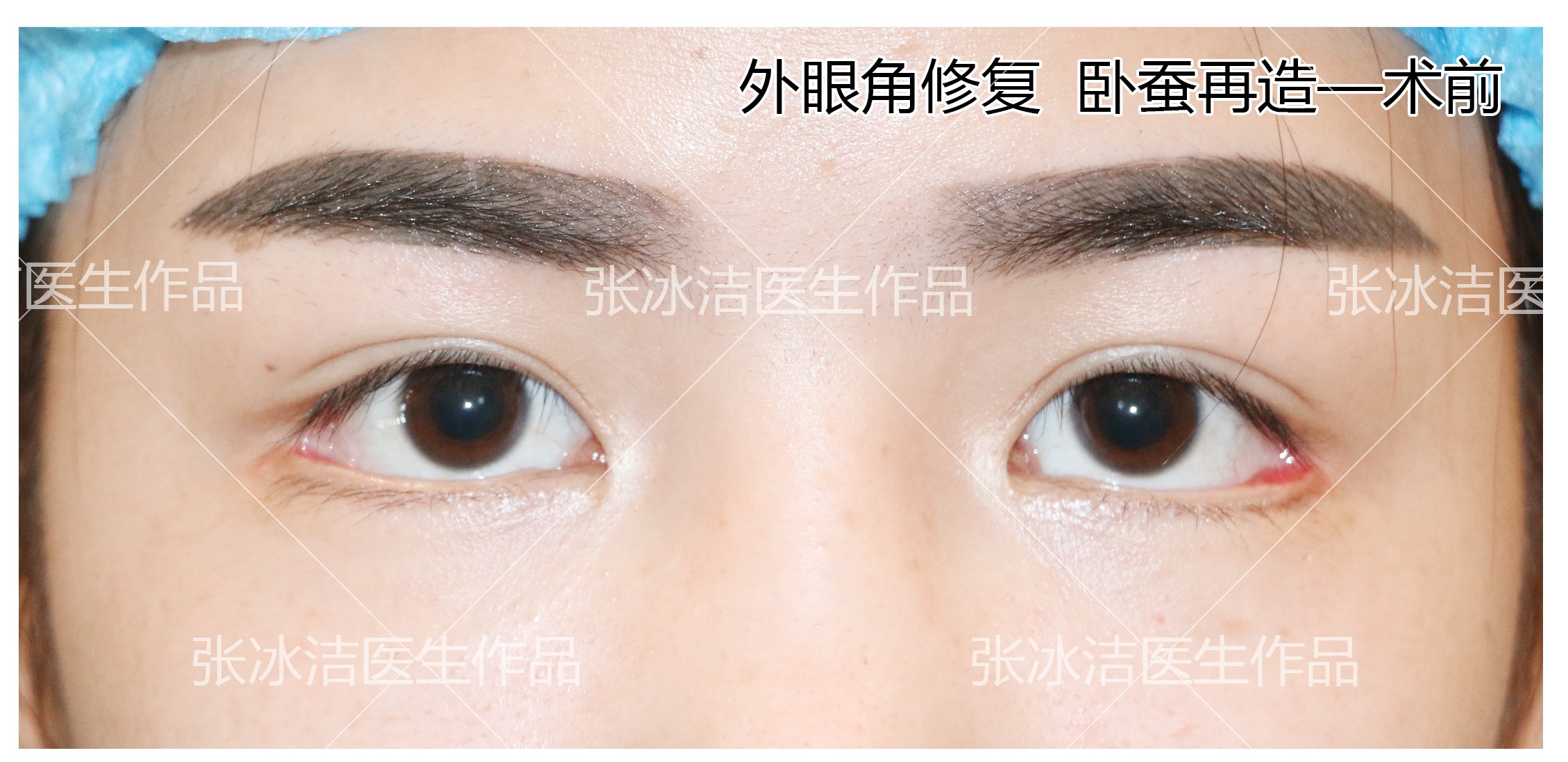 张冰洁谈下睑外翻修复丨真皮卧蚕在下睑外翻中应用 张冰杰主治医师 爱问医生